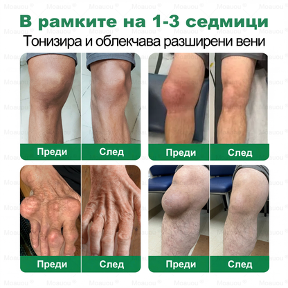 🇧🇬👨‍⚕️✅✅ Moauou® Крем за вени и стави – целенасочено действие ⚡ Мигновено облекчение, дълготрайни резултати | Голяма разпродажба!